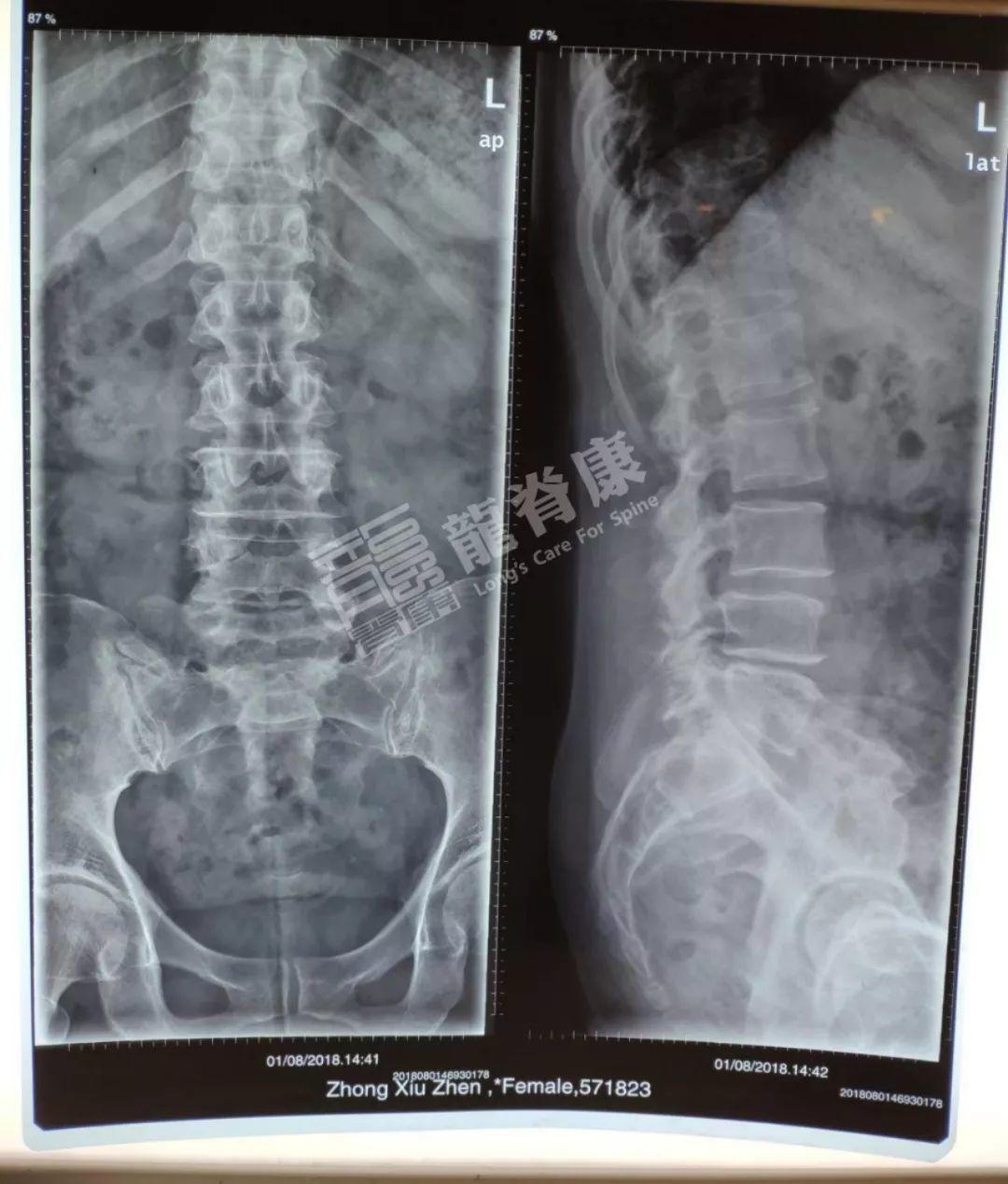 腰突手術(shù)最新進(jìn)展，小巷深處的神秘醫(yī)療之旅探索