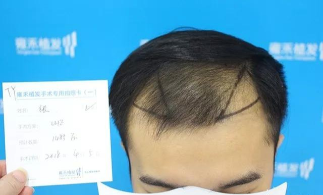 雄脫最新治療探索，小巷深處的秘密小店