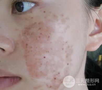 激光祛斑價格解析，探索與影響因素