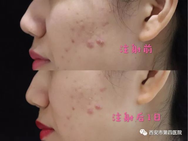 最新痤瘡治療技術(shù)，開啟美麗肌膚之門