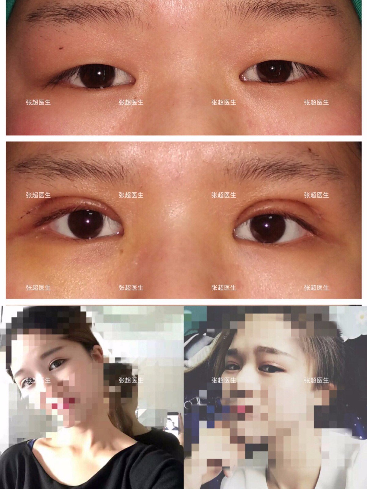 科技重塑美麗，雙眼皮開眼角價(jià)格詳解，開啟未來美學(xué)之旅